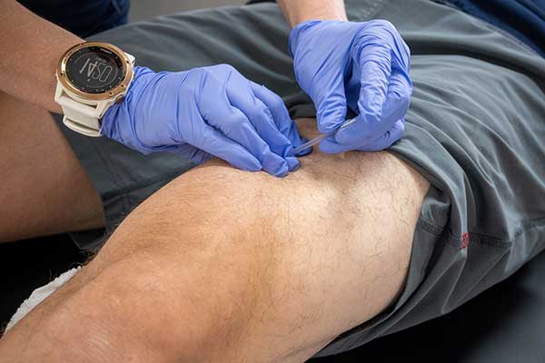 dry needling on a patient's leg