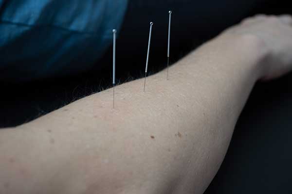 dry needling patient's arm