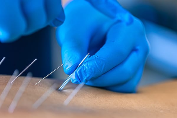 Close up of physical therapist dry needling patient's back