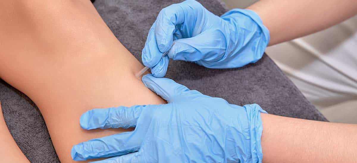 Dry Needling: Benefits for Pain Relief and Orthopedic Recovery